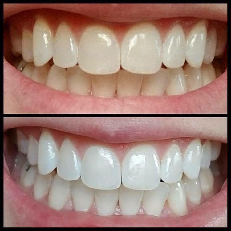 Whitening Toothpaste