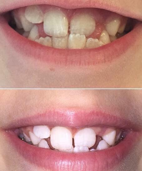 Whitening Toothpaste