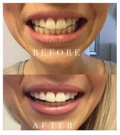 Whitening Toothpaste