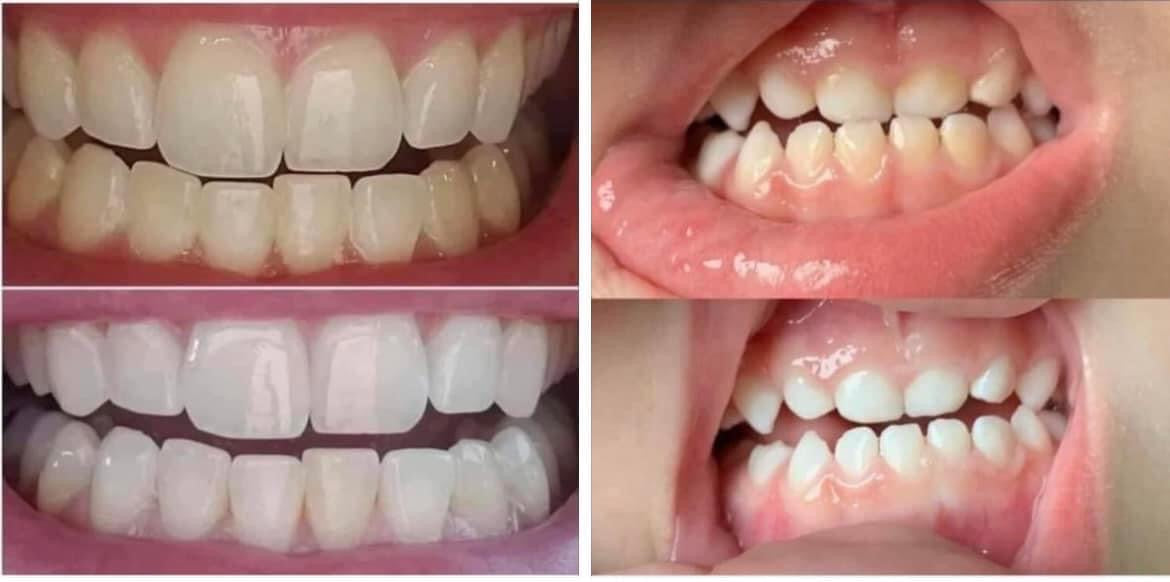 Whitening Toothpaste